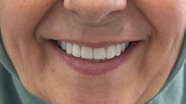 İmplant tedavisi öncesi ve sonrası