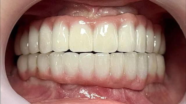 Zirkonyum kaplama öncesi ve sonrası - Sonra